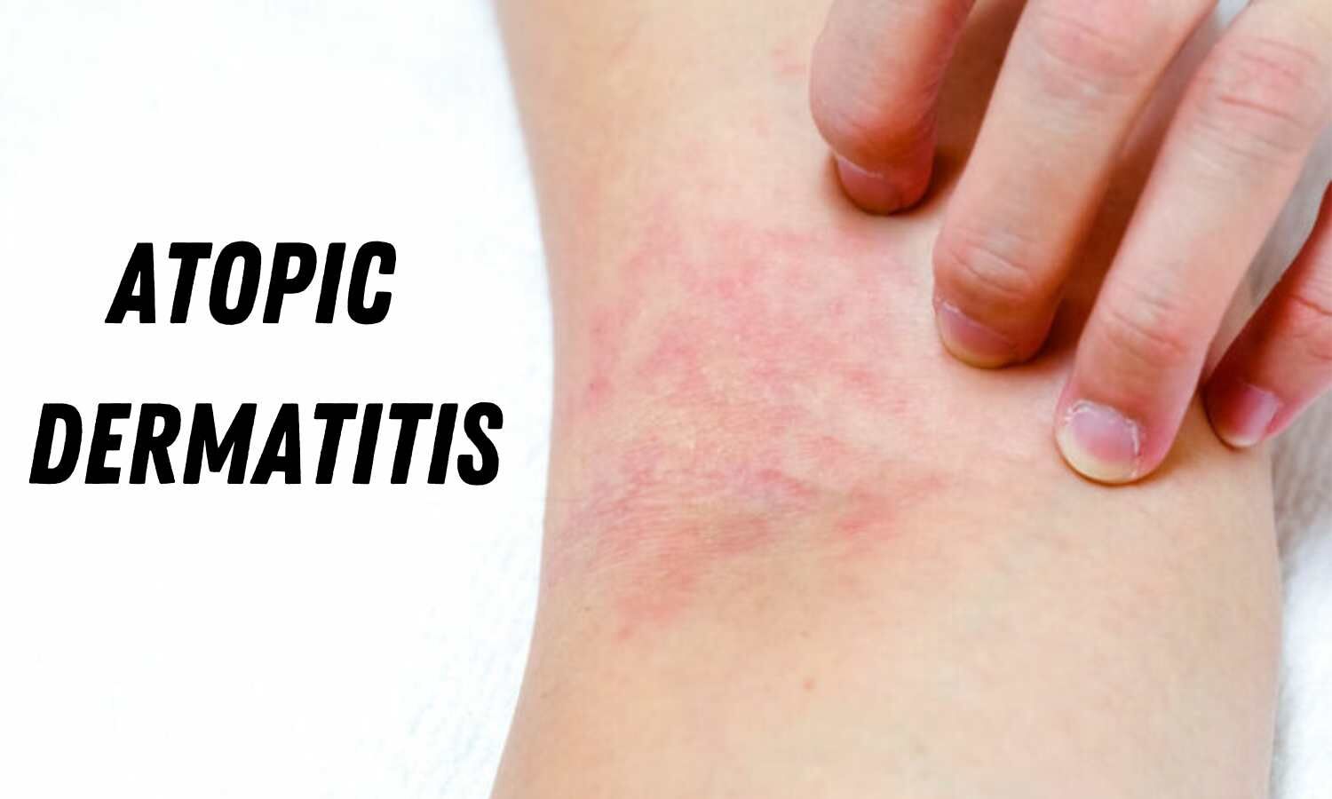 Atopic Eczema