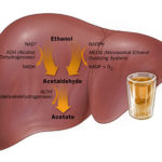 Alcohol Related Liver Disease