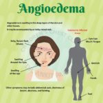 Angioedema