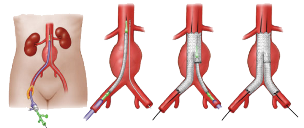 Abdominal Aortic Aneurysm