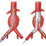 Abdominal Aortic Aneurysm