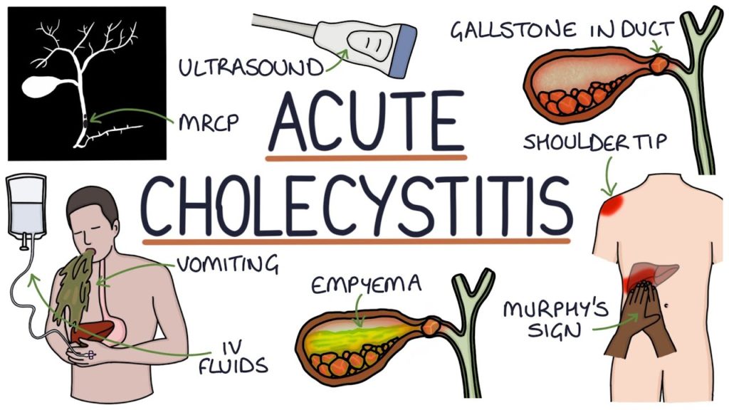 Acute Cholecystitis