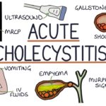 Acute Cholecystitis